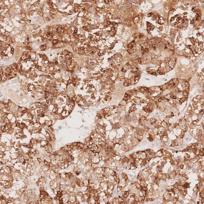 Immunohistochemistry (IHC) staining of human pituitary adenoma tissue using Chromogranin A Monoclonal antibody (60135-2-Ig)