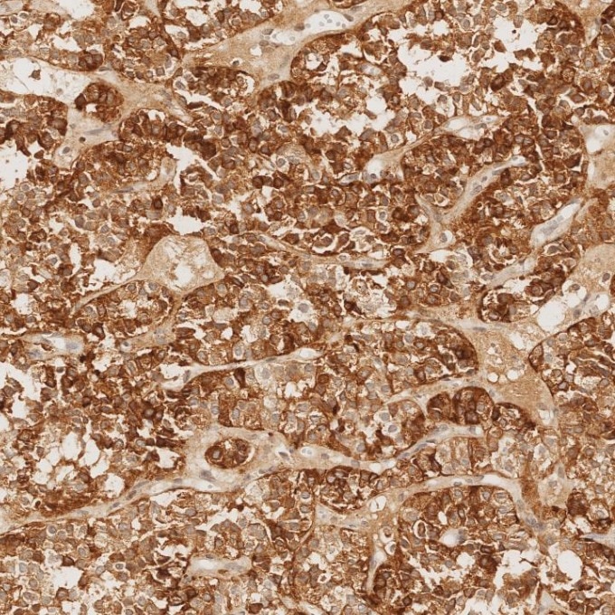 Immunohistochemistry (IHC) staining of human pituitary adenoma tissue using Chromogranin A Monoclonal antibody (60135-2-Ig)