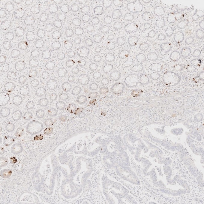 Immunohistochemistry (IHC) staining of human colorectal cancer tissue using Chromogranin A Monoclonal antibody (60135-2-Ig)