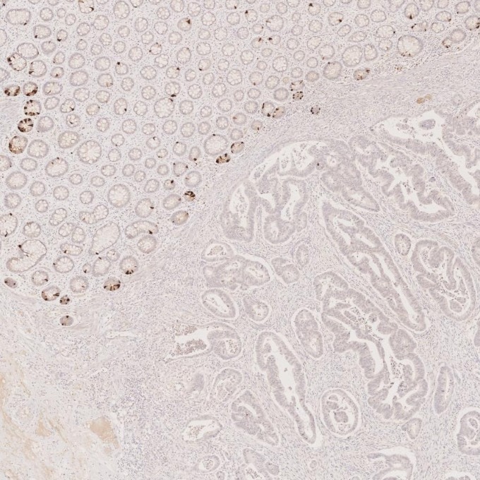 Immunohistochemistry (IHC) staining of human colorectal cancer tissue using Chromogranin A Monoclonal antibody (60135-2-Ig)