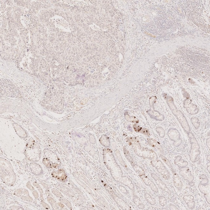 Immunohistochemistry (IHC) staining of human stomach cancer tissue using Chromogranin A Monoclonal antibody (60135-2-Ig)