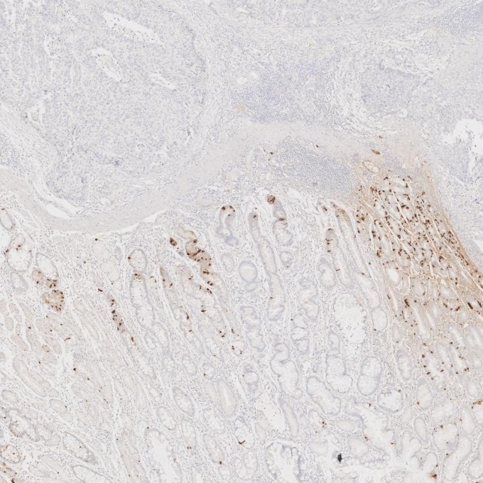 Immunohistochemistry (IHC) staining of human stomach cancer tissue using Chromogranin A Monoclonal antibody (60135-2-Ig)