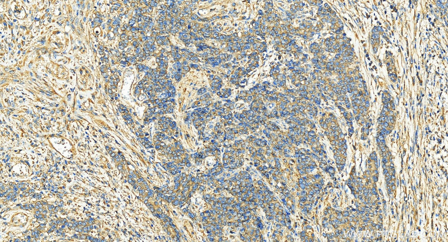 Immunohistochemistry (IHC) staining of human stomach cancer tissue using Dynamitin (1-401 AA) Polyclonal antibody (11361-1-AP)