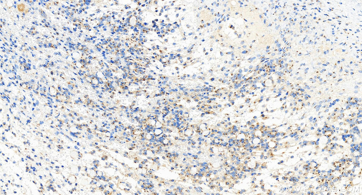 Immunohistochemistry (IHC) staining of human ovary cancer tissue using golgin 97 Recombinant antibody (83009-4-RR)