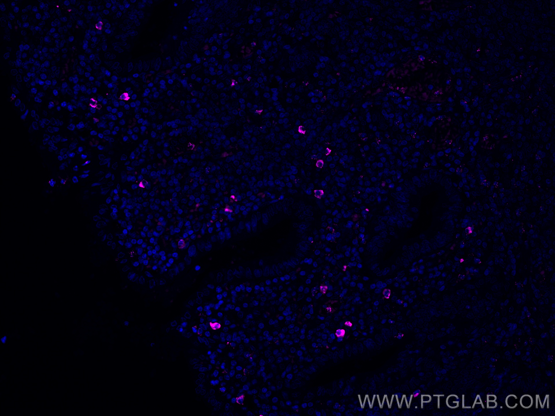 Immunofluorescence (IF) / fluorescent staining of human appendicitis tissue using CoraLite® Plus 647-conjugated human IgM Monoclonal (CL647-66484)