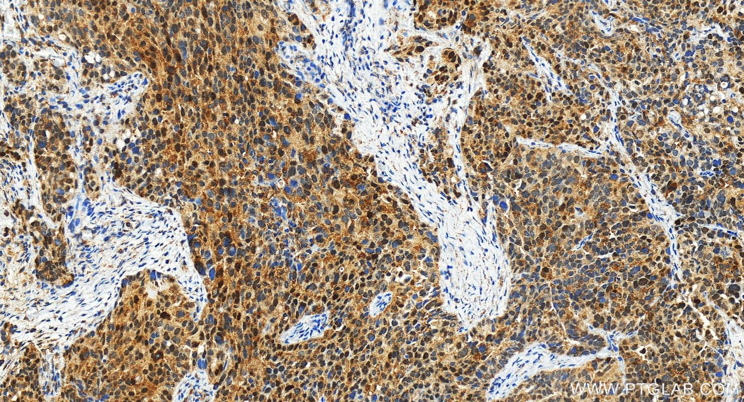 Immunohistochemistry (IHC) staining of human ovary cancer tissue using p14ARF/p19ARF Polyclonal antibody (31221-1-AP)