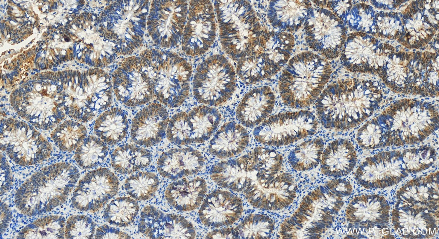 Immunohistochemistry (IHC) staining of human colon cancer tissue using p38 MAPK Polyclonal antibody (14064-1-AP)