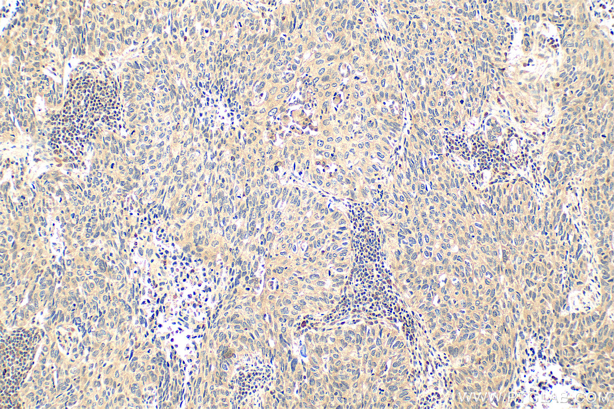 Immunohistochemistry (IHC) staining of human lung cancer tissue using Multi-rAb™ p38 MAPK Multi-Recombinant antibody (RMX00006)