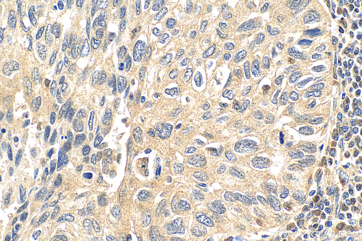 Immunohistochemistry (IHC) staining of human lung cancer tissue using Multi-rAb™ p38 MAPK Multi-Recombinant antibody (RMX00006)