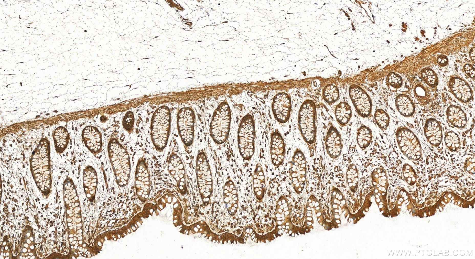 Immunohistochemistry (IHC) staining of human colon tissue using NF-κB p65 Polyclonal antibody (10745-1-AP)