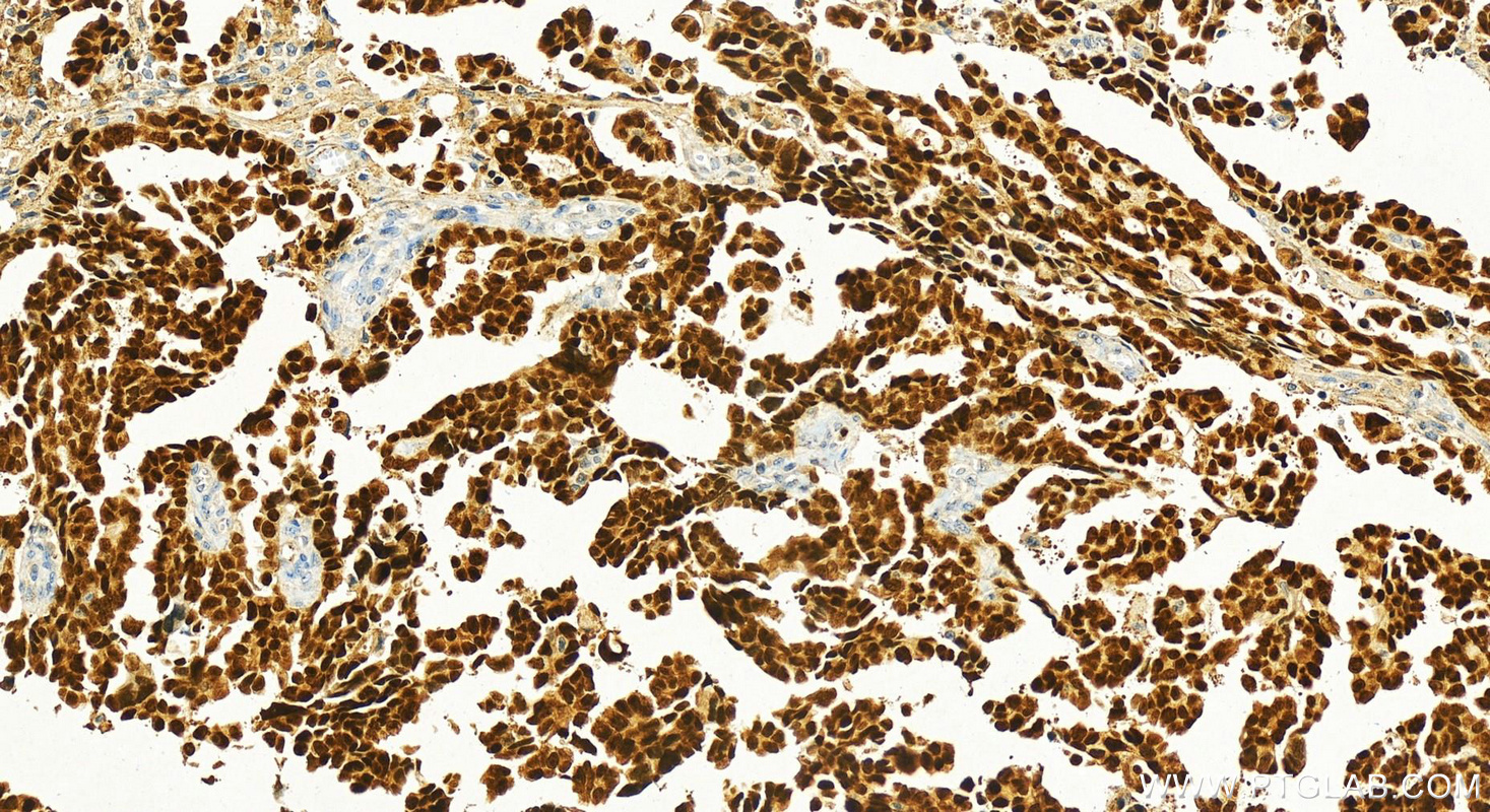 Immunohistochemistry (IHC) staining of human ovary cancer tissue using Pan-PAX Polyclonal antibody (21383-1-AP)