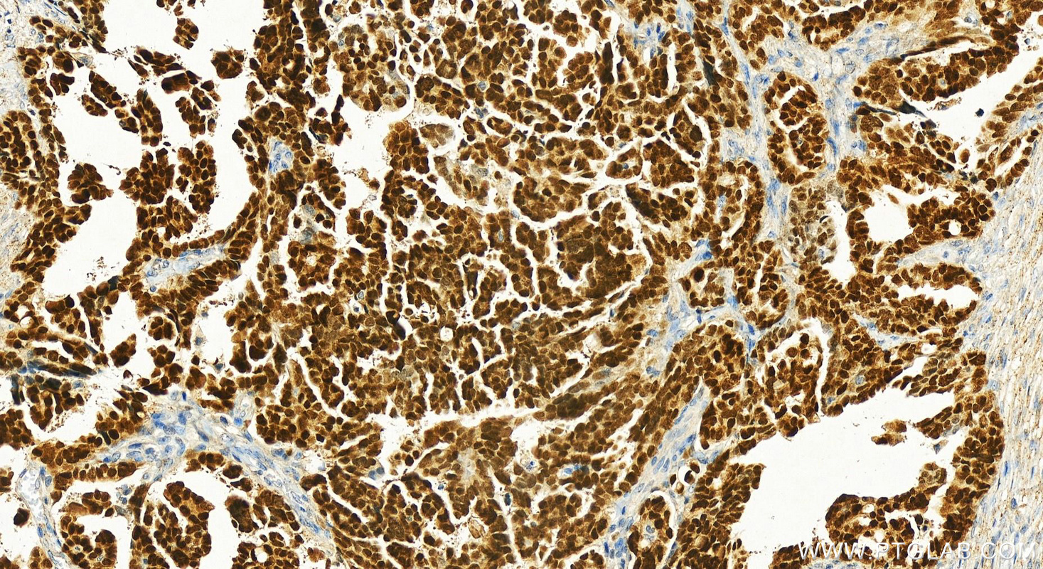 Immunohistochemistry (IHC) staining of human ovary cancer tissue using Pan-PAX Polyclonal antibody (21383-1-AP)