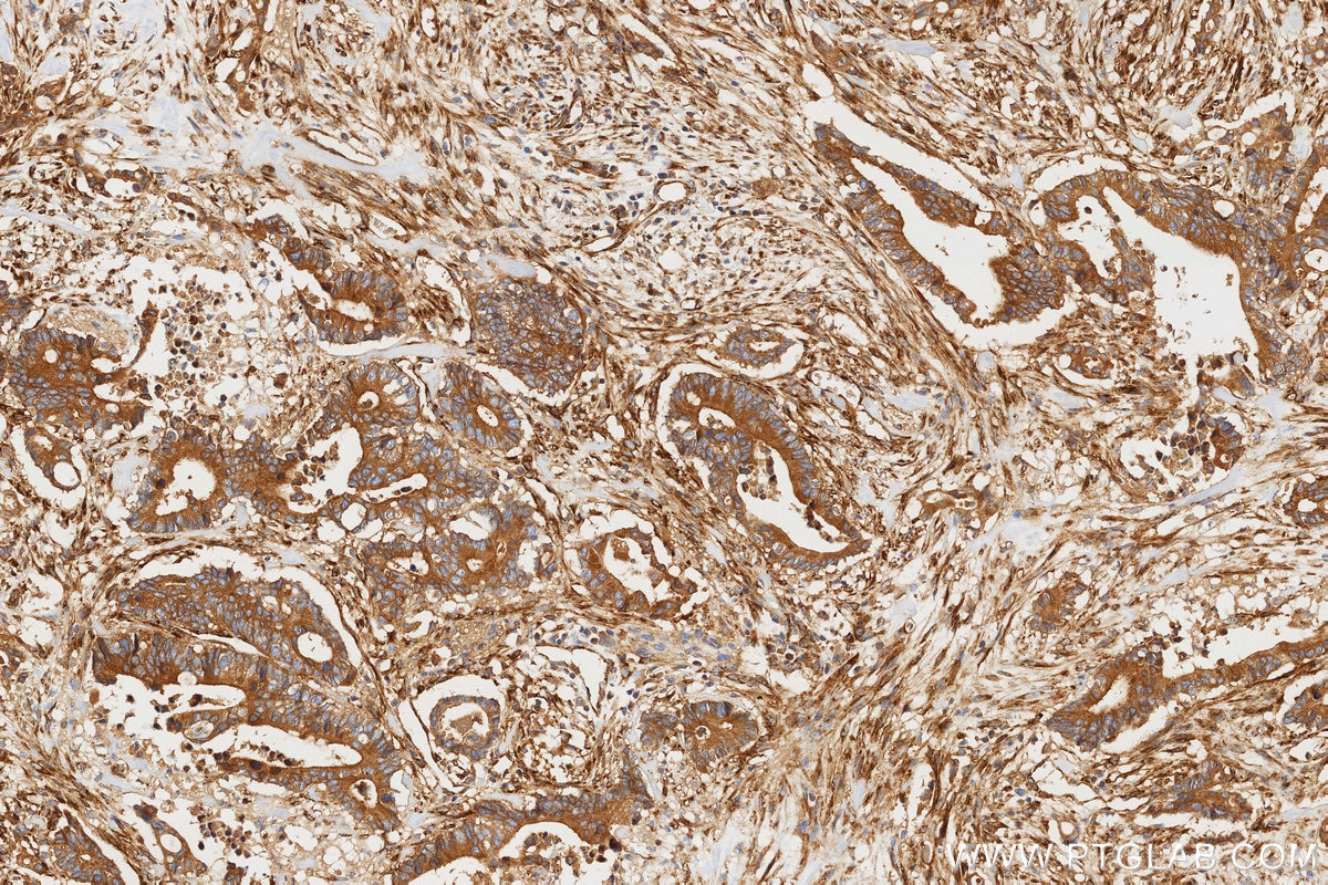Immunohistochemistry (IHC) staining of human rectal cancer tissue using pan RAS Recombinant monoclonal antibody (81615-1-RR)