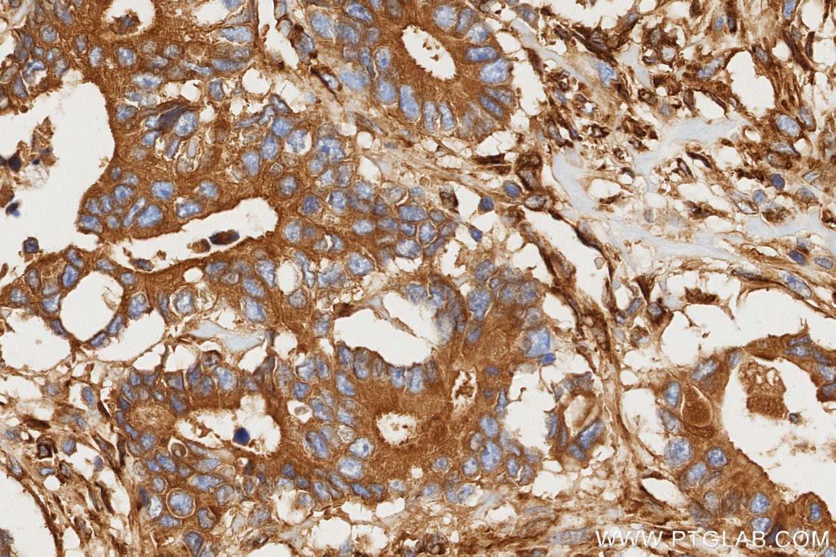 Immunohistochemistry (IHC) staining of human rectal cancer tissue using pan RAS Recombinant monoclonal antibody (81615-1-RR)