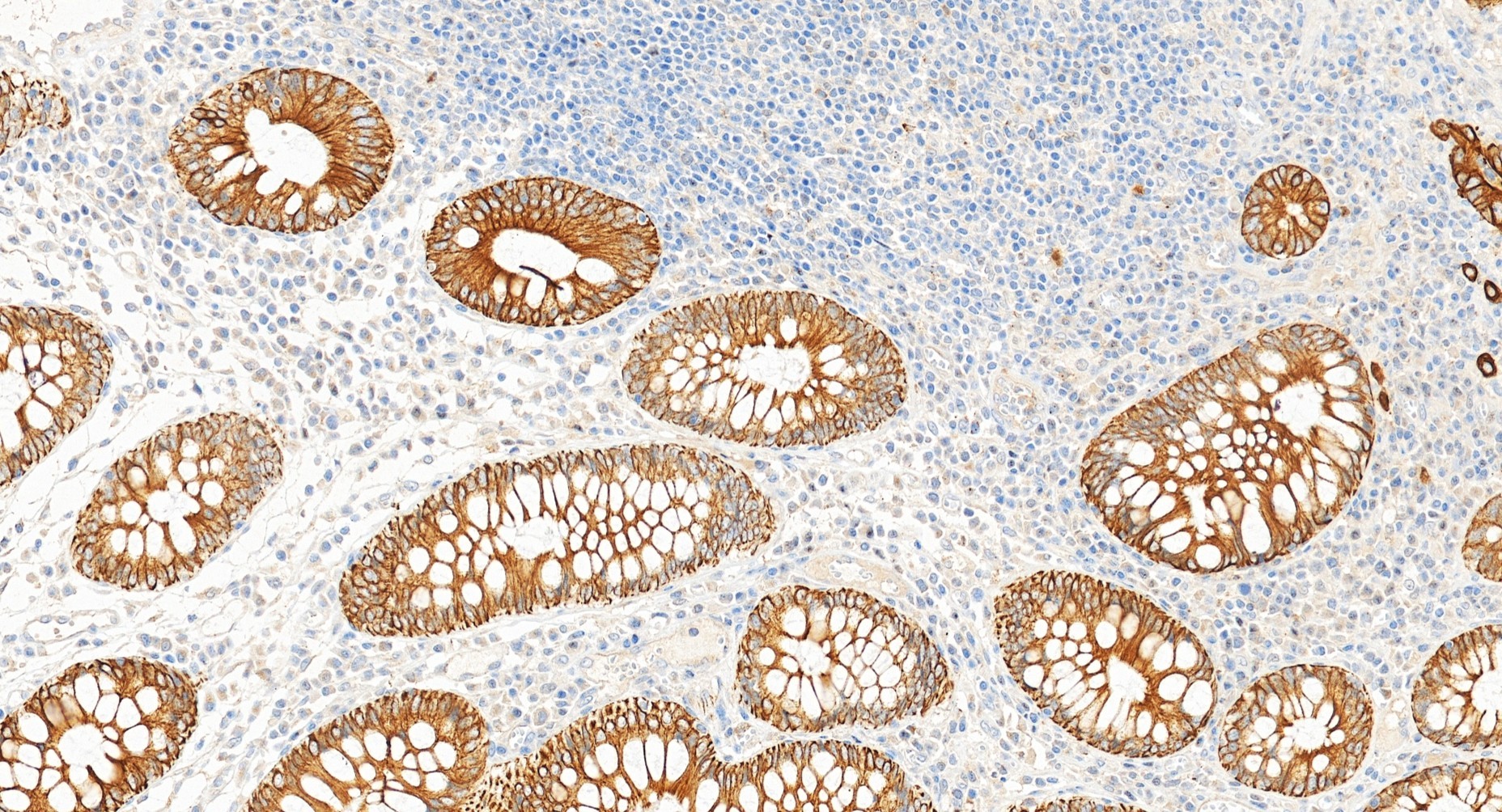 Immunohistochemistry (IHC) staining of human colon cancer tissue using Pan-Keratin Polyclonal antibody (26411-1-AP)