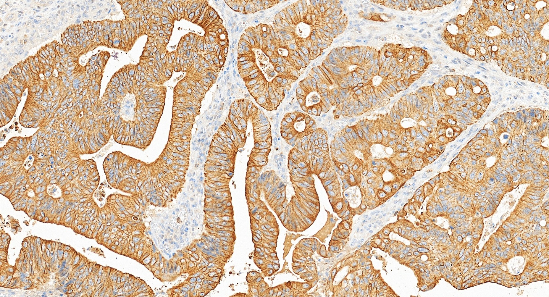 Immunohistochemistry (IHC) staining of human colon cancer tissue using Pan-Keratin Polyclonal antibody (26411-1-AP)