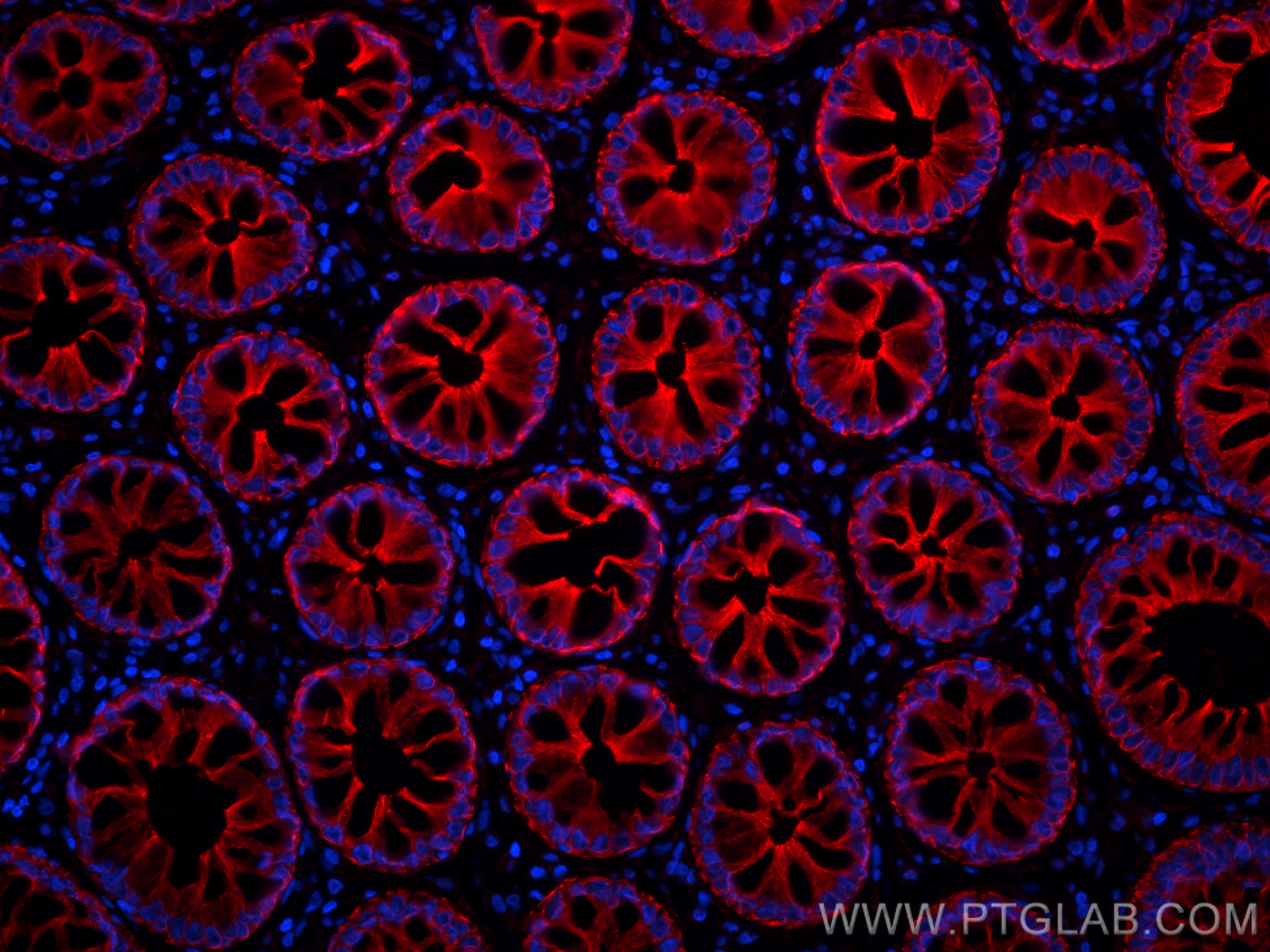 Immunofluorescence (IF) / fluorescent staining of human rectal cancer tissue using pan-keratin Polyclonal antibody (26411-1-AP)