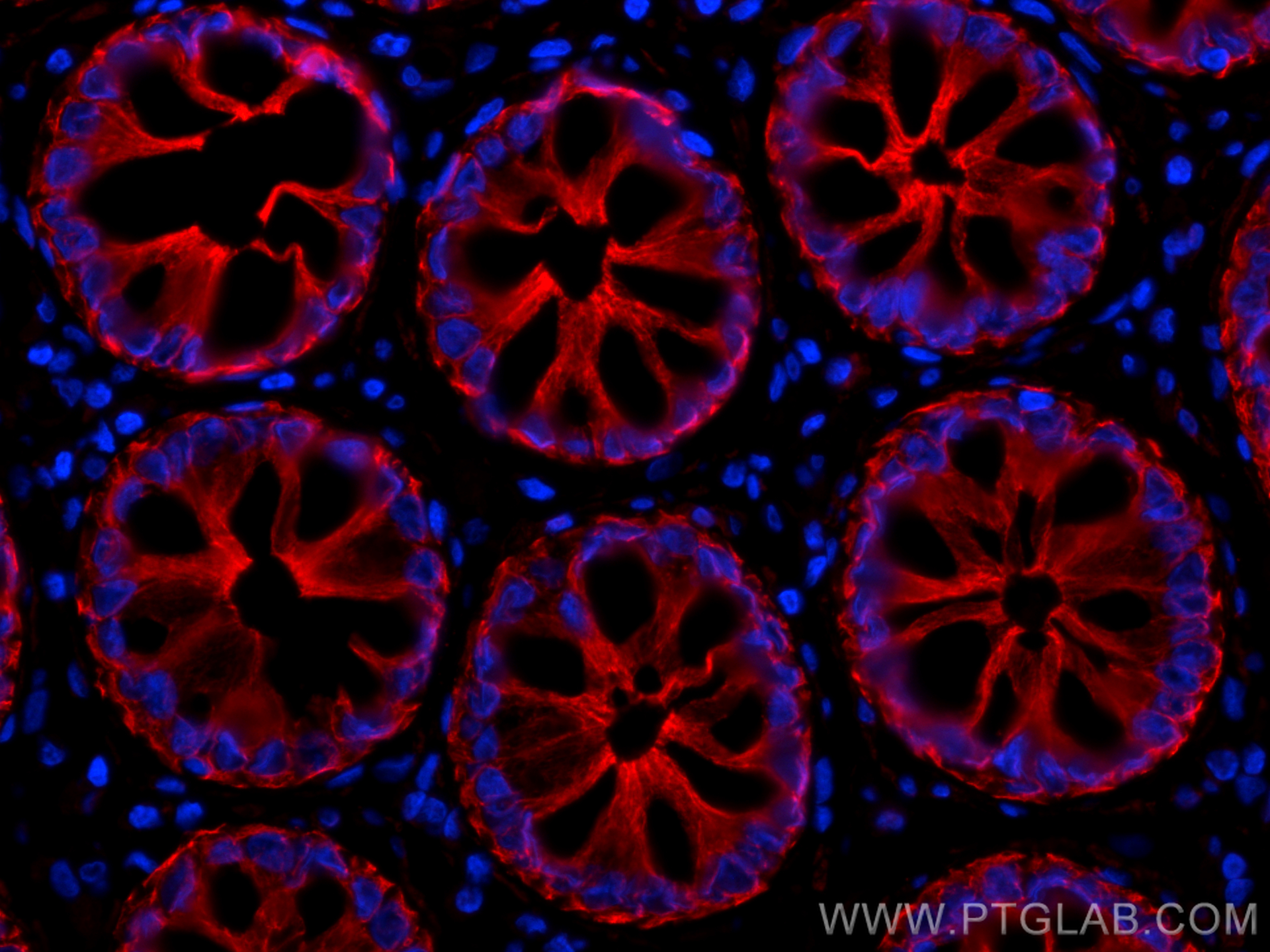 Immunofluorescence (IF) / fluorescent staining of human rectal cancer tissue using pan-keratin Polyclonal antibody (26411-1-AP)