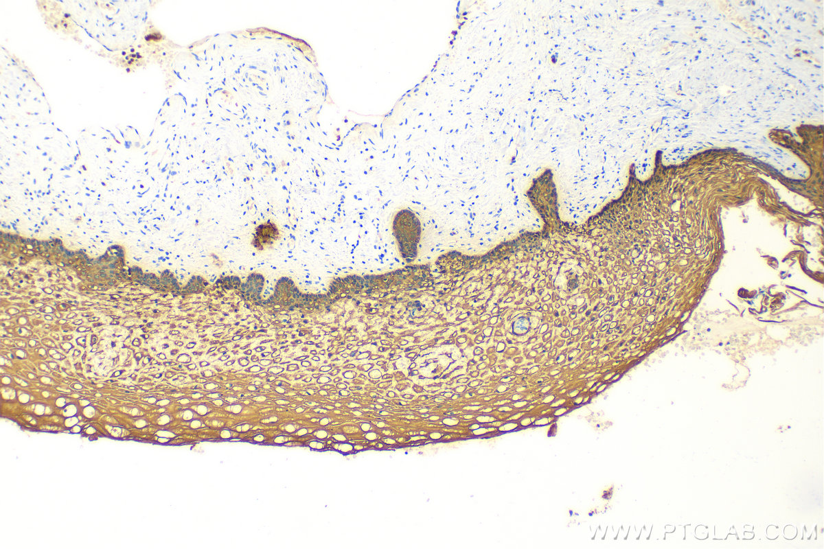 Immunohistochemistry (IHC) staining of human cervical cancer tissue using pan-keratin Polyclonal antibody (26411-1-AP)