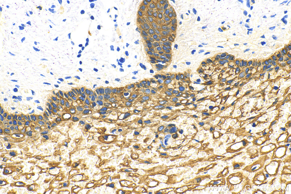 Immunohistochemistry (IHC) staining of human cervical cancer tissue using pan-keratin Polyclonal antibody (26411-1-AP)