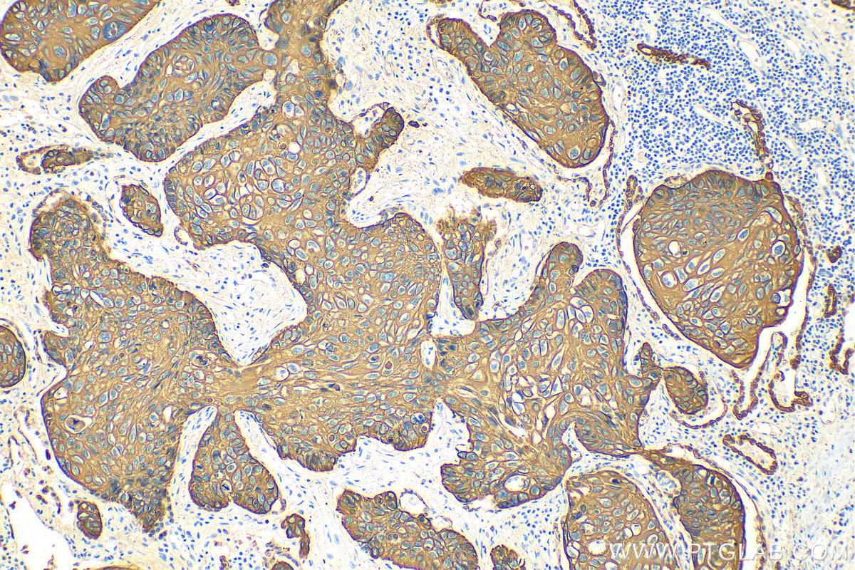 Immunohistochemistry (IHC) staining of human lung cancer tissue using pan-keratin Polyclonal antibody (26411-1-AP)