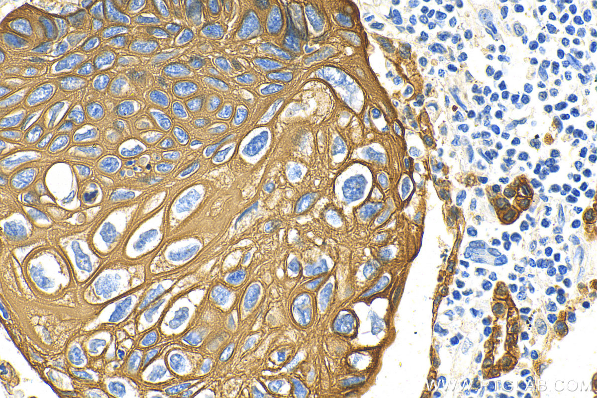 Immunohistochemistry (IHC) staining of human lung cancer tissue using pan-keratin Polyclonal antibody (26411-1-AP)