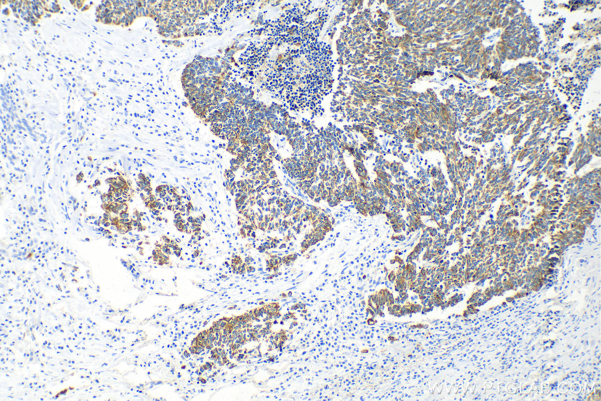 Immunohistochemistry (IHC) staining of human lung cancer tissue using pan-keratin Polyclonal antibody (26411-1-AP)