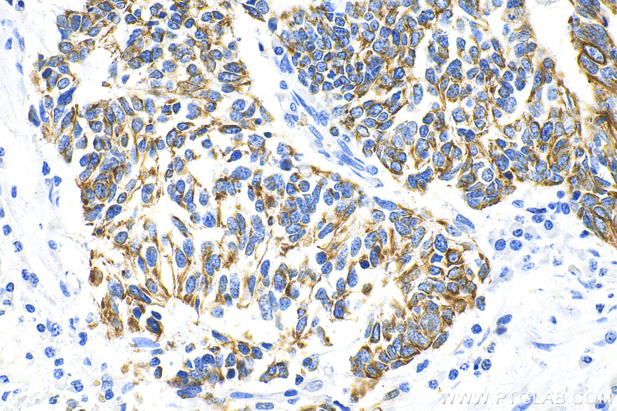 Immunohistochemistry (IHC) staining of human lung cancer tissue using pan-keratin Polyclonal antibody (26411-1-AP)