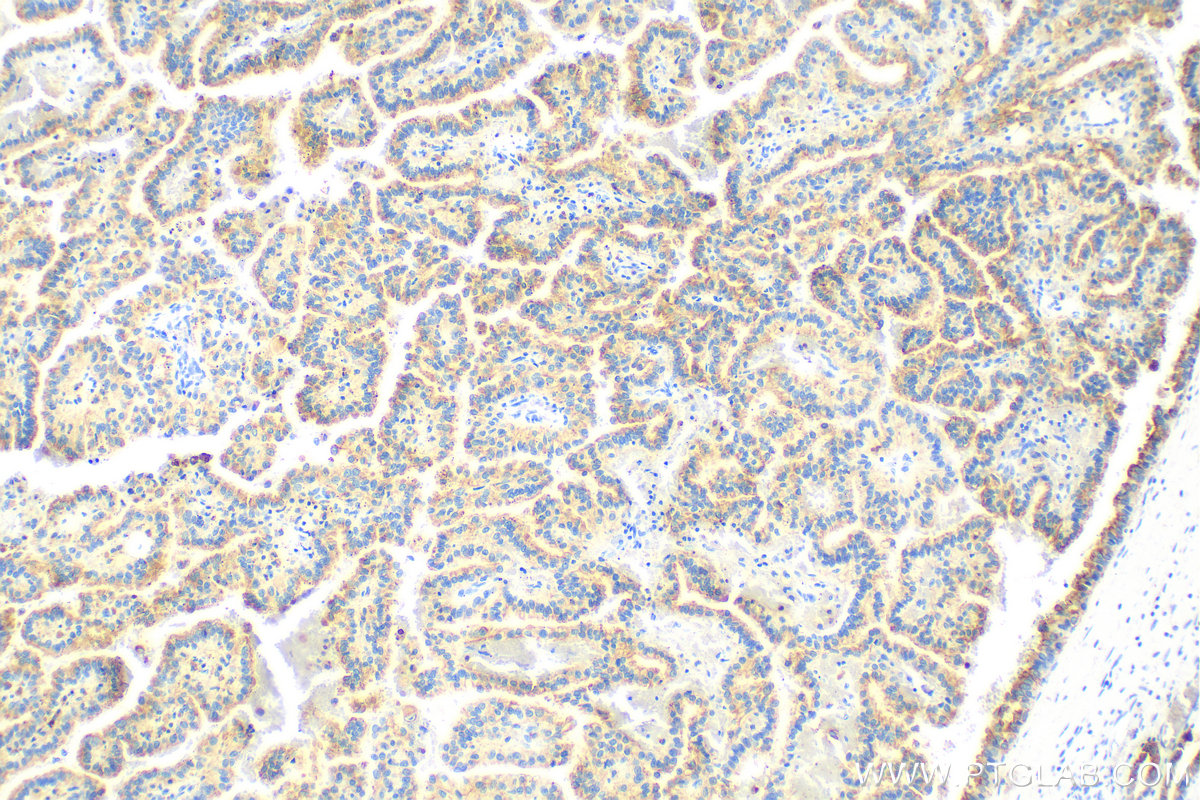 Immunohistochemistry (IHC) staining of human renal cell carcinoma tissue using pan-keratin Polyclonal antibody (26411-1-AP)