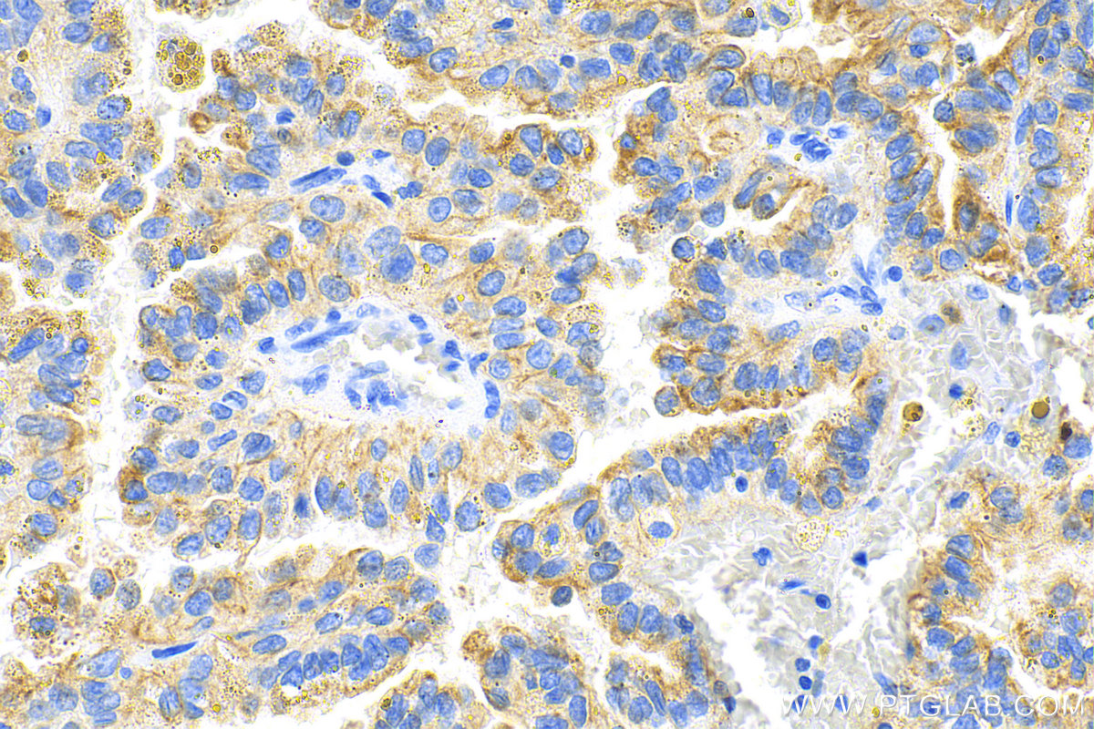 Immunohistochemistry (IHC) staining of human renal cell carcinoma tissue using pan-keratin Polyclonal antibody (26411-1-AP)