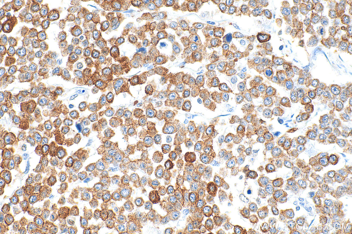 Immunohistochemistry (IHC) staining of human colon cancer tissue using Pan-Keratin Polyclonal antibody (26411-1-AP)