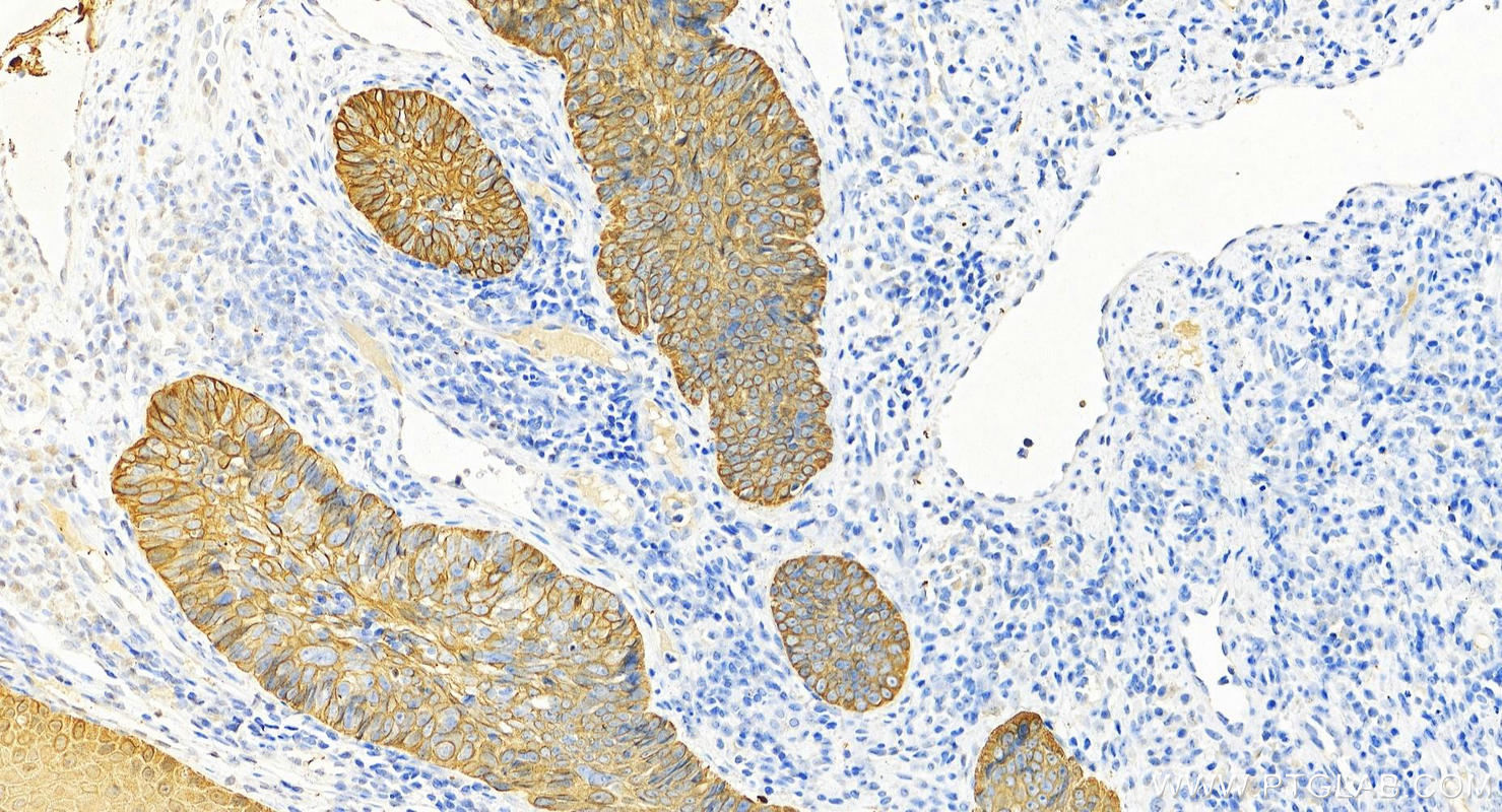 Immunohistochemistry (IHC) staining of human brown disease using pan-keratin Polyclonal antibody (26411-1-AP)