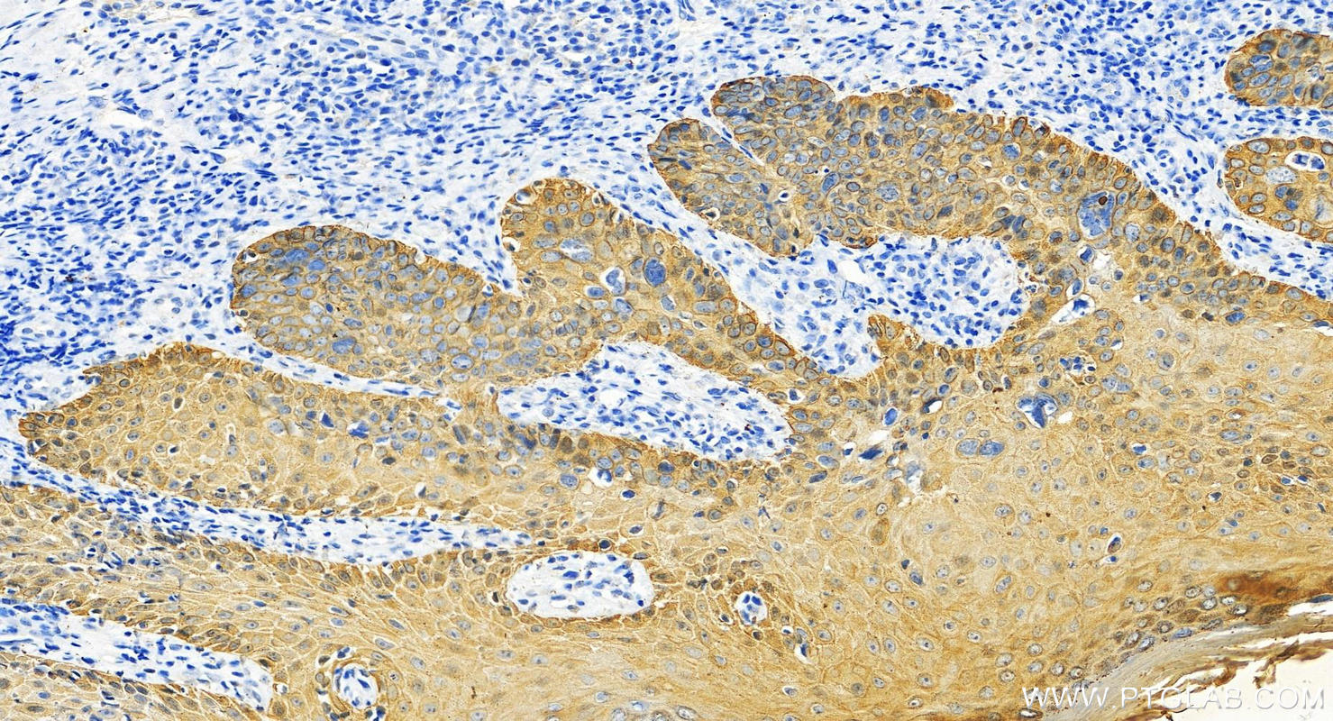 Immunohistochemistry (IHC) staining of human brown disease using pan-keratin Polyclonal antibody (26411-1-AP)