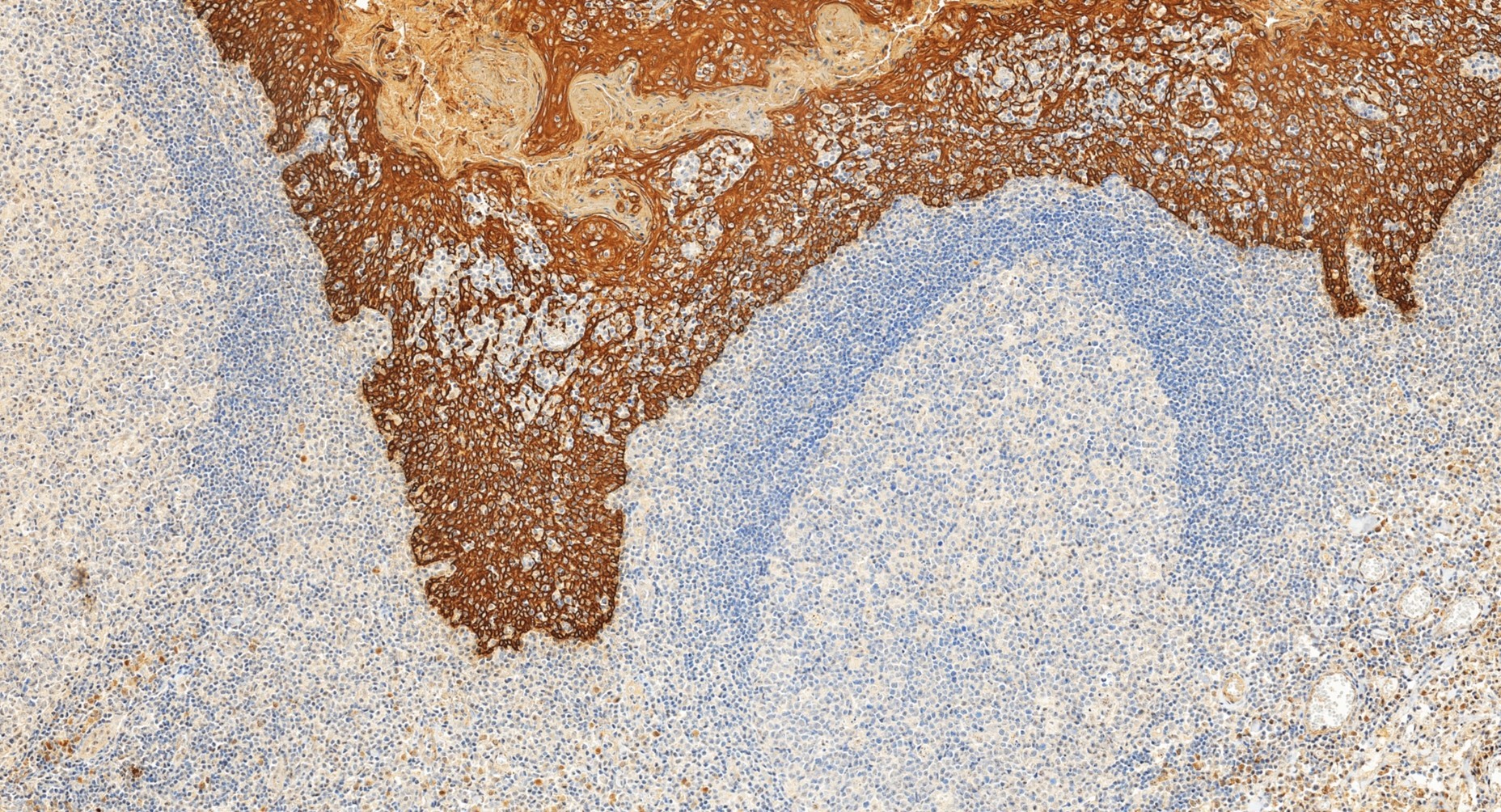 Immunohistochemistry (IHC) staining of human tonsillitis tissue using Pan-Keratin Polyclonal antibody (26411-1-AP)