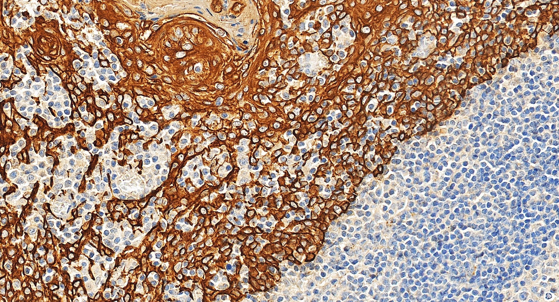 Immunohistochemistry (IHC) staining of human tonsillitis tissue using Pan-Keratin Polyclonal antibody (26411-1-AP)