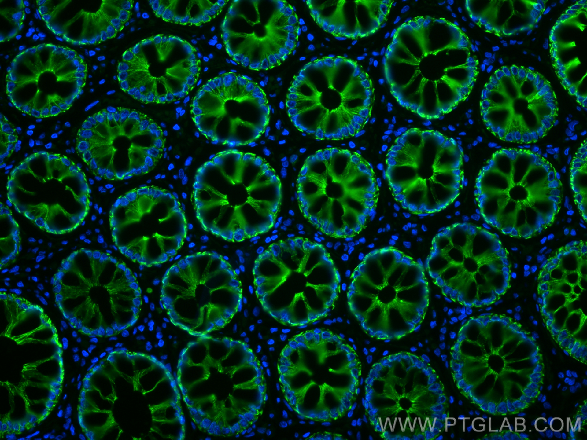 Immunofluorescence (IF) / fluorescent staining of human rectal cancer tissue using CoraLite® Plus 488-conjugated pan-keratin Polyclon (CL488-26411)