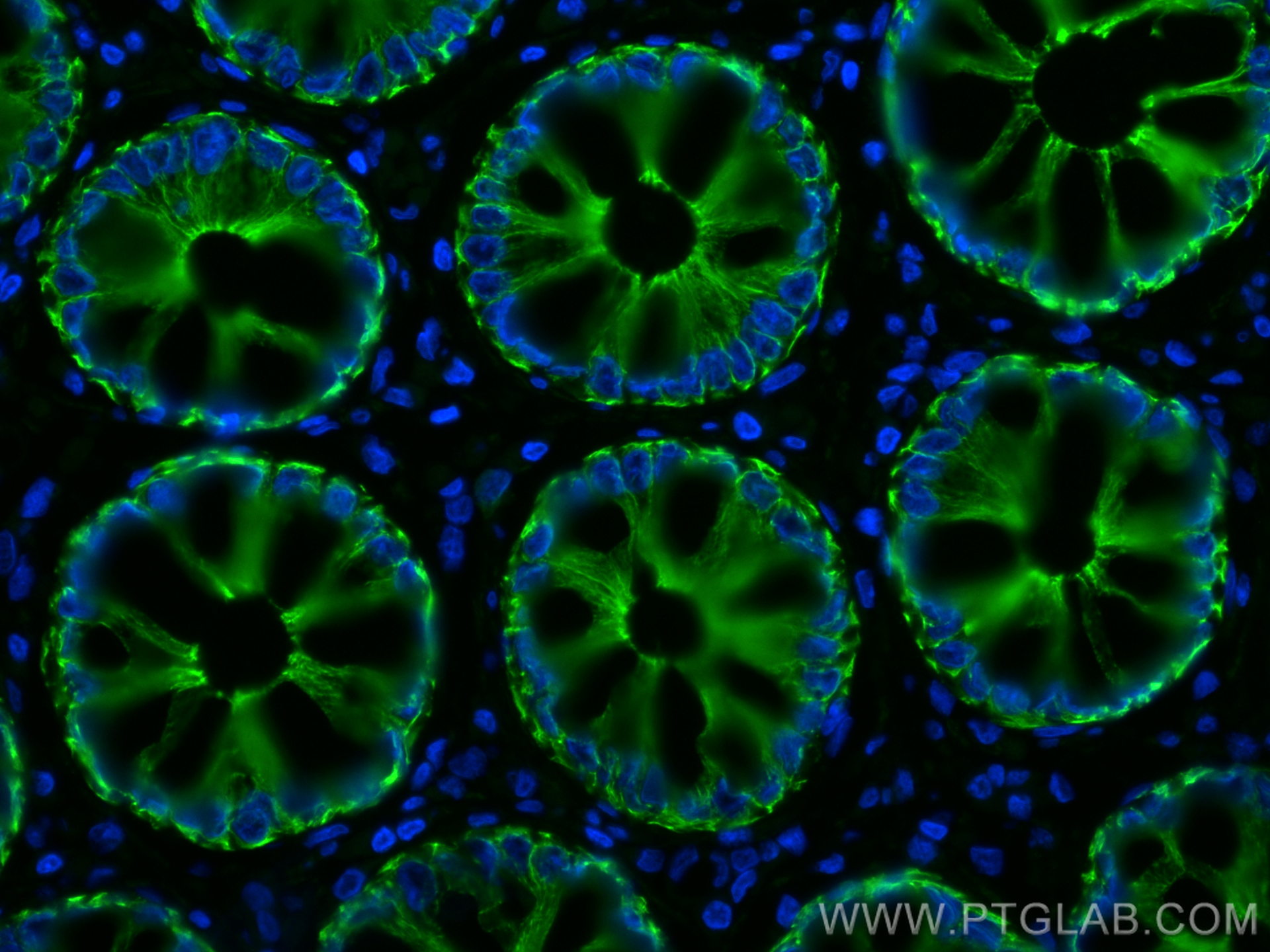 Immunofluorescence (IF) / fluorescent staining of human rectal cancer tissue using CoraLite® Plus 488-conjugated pan-keratin Polyclon (CL488-26411)