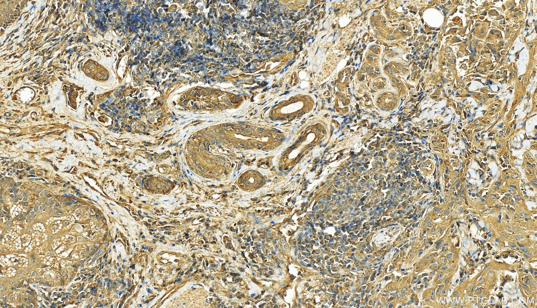 Immunohistochemistry (IHC) staining of human skin cancer tissue using Gamma Tubulin Polyclonal antibody (26195-1-AP)