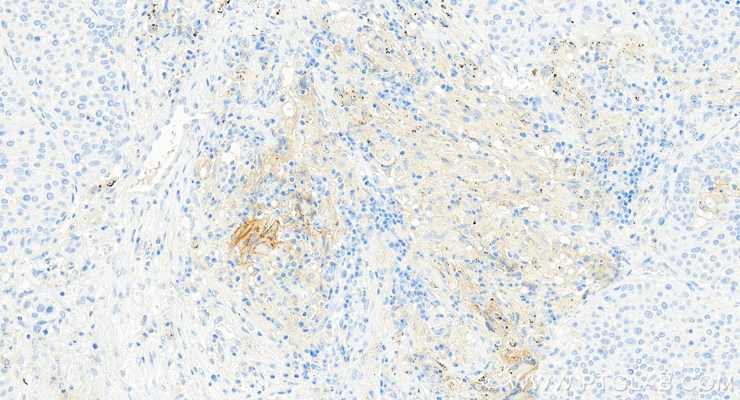 Immunohistochemistry (IHC) staining of human lung squamous cell cancer using uPAR/CD87 Monoclonal antibody (68727-1-Ig)