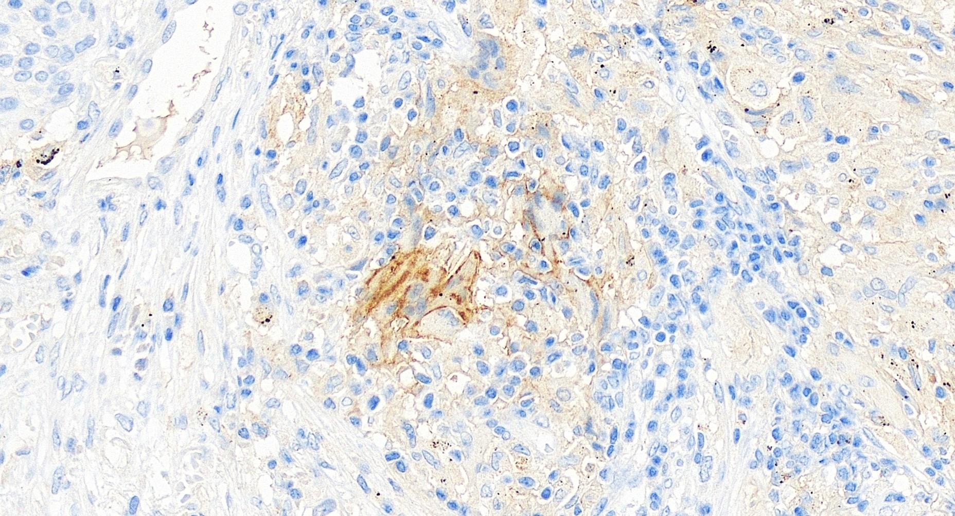 Immunohistochemistry (IHC) staining of human lung squamous cell cancer using uPAR/CD87 Monoclonal antibody (68727-1-Ig)