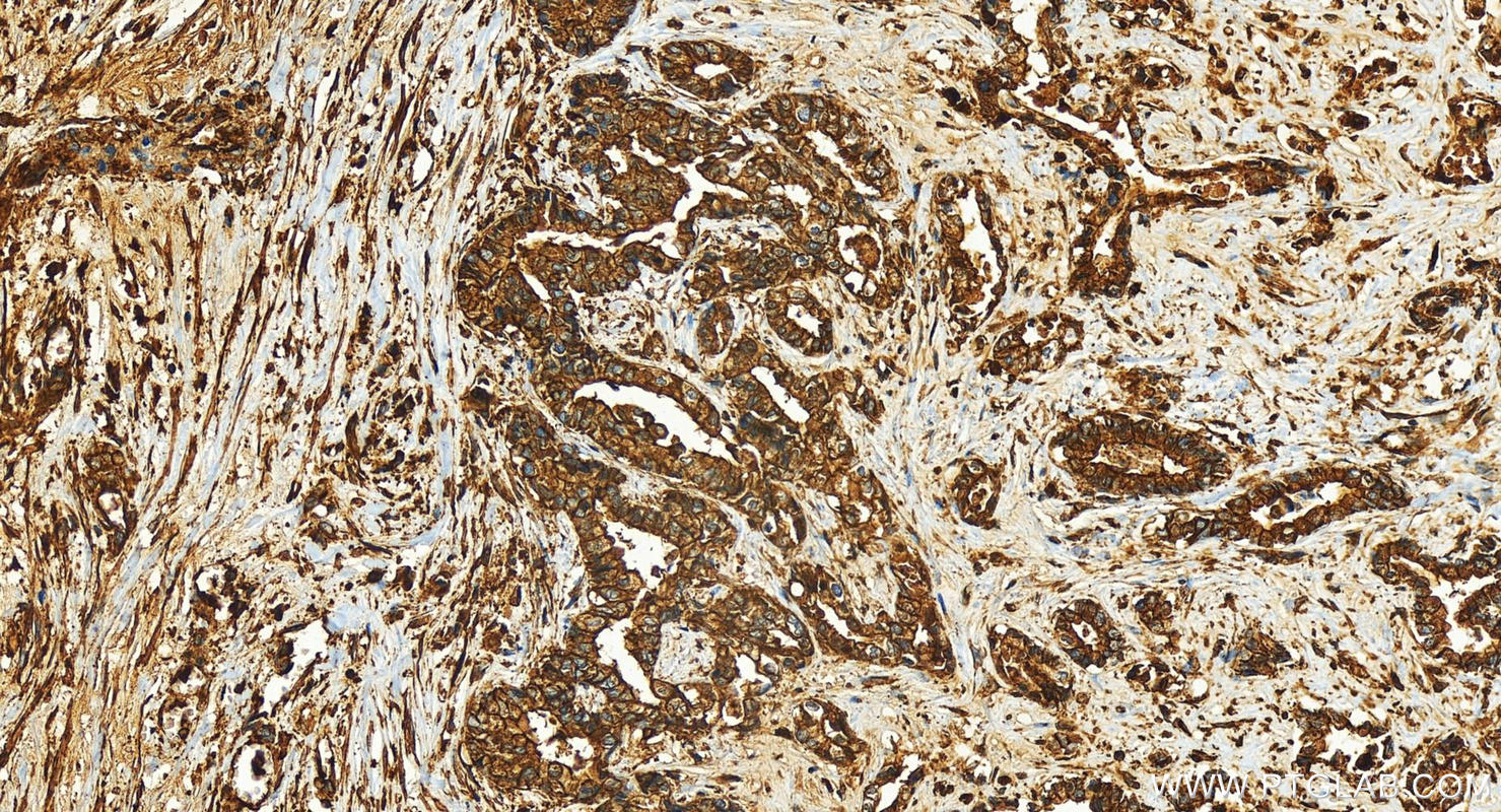 Immunohistochemistry (IHC) staining of human intrahepatic cholangiocarcinoma tissue using uPAR/CD87 Recombinant antibody (82953-2-RR)