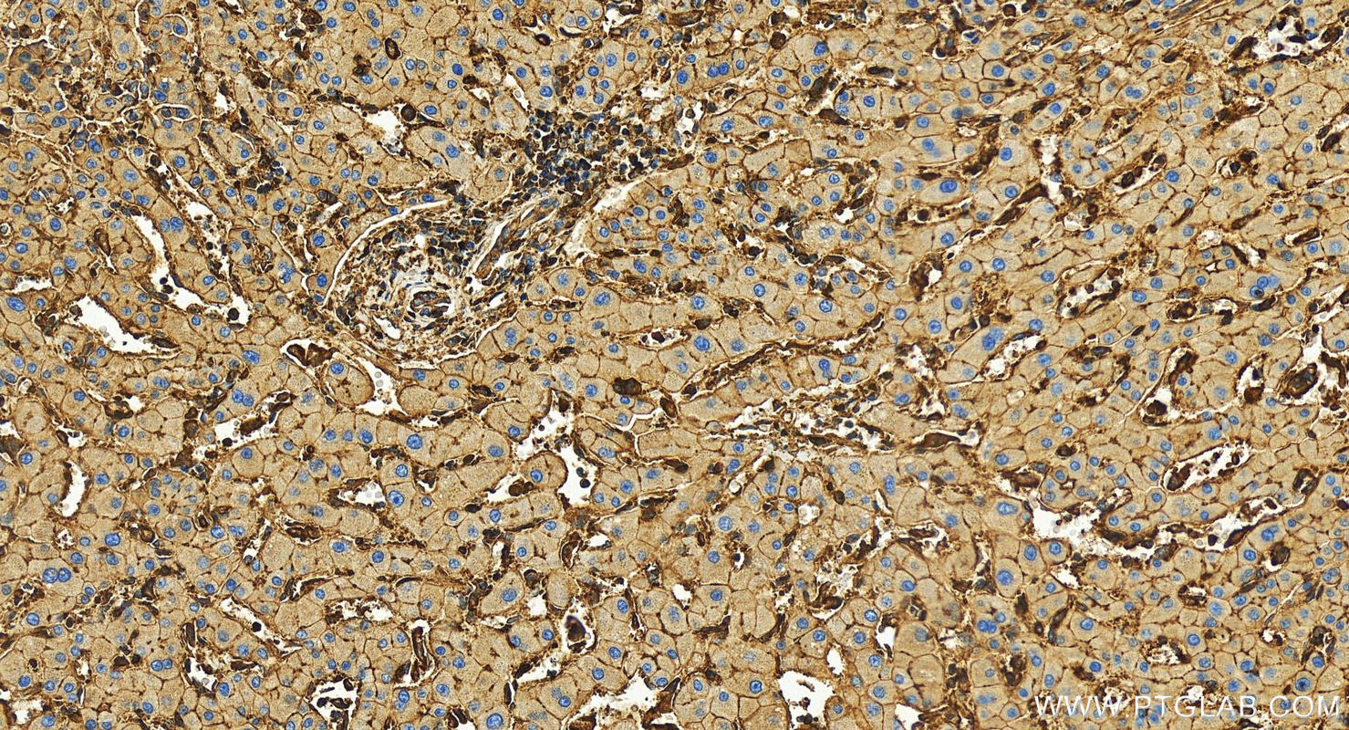 Immunohistochemistry (IHC) staining of human intrahepatic cholangiocarcinoma tissue using uPAR/CD87 Recombinant antibody (82953-2-RR)