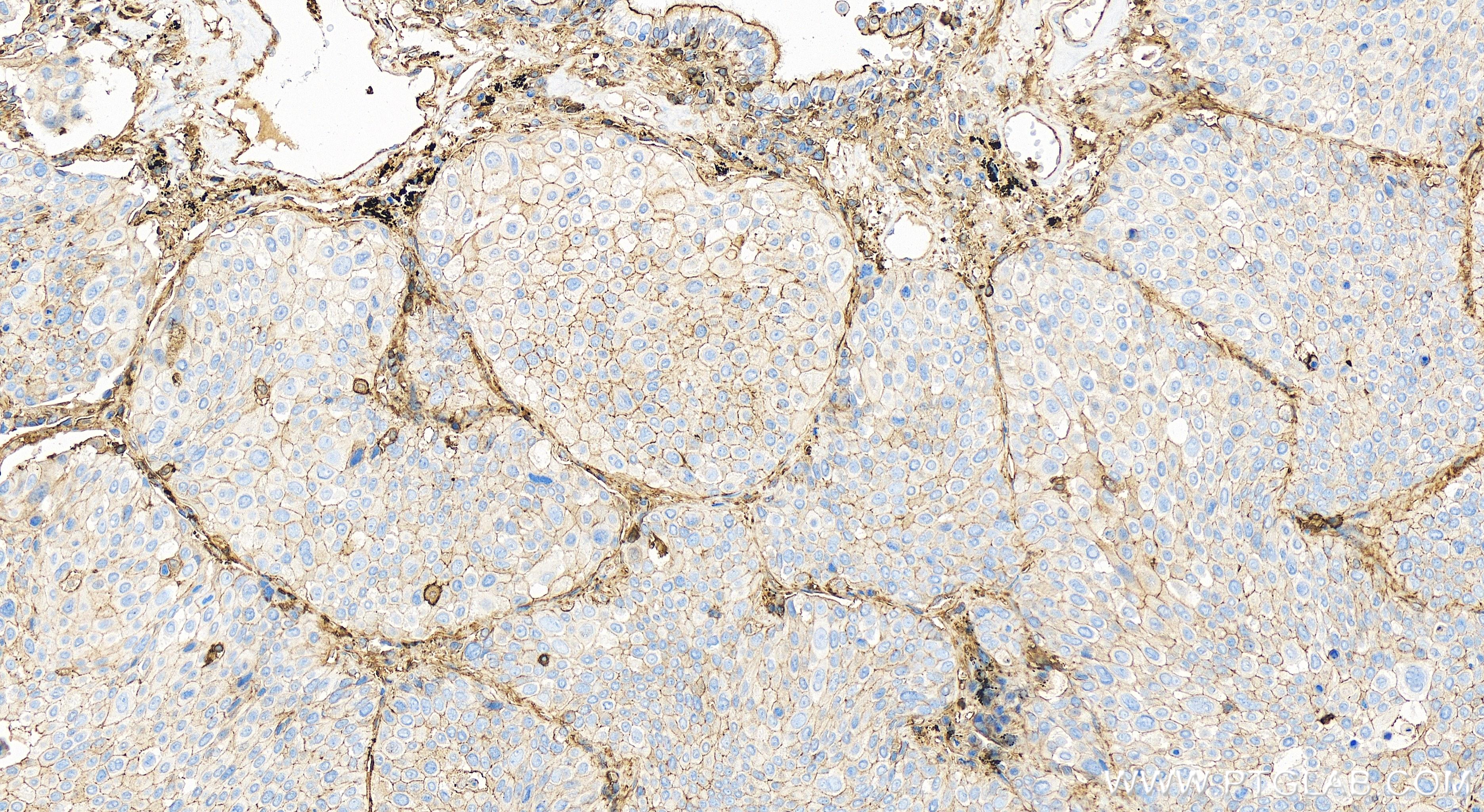 Immunohistochemistry (IHC) staining of human lung cancer tissue using uPAR/CD87 Recombinant antibody (82953-2-RR)