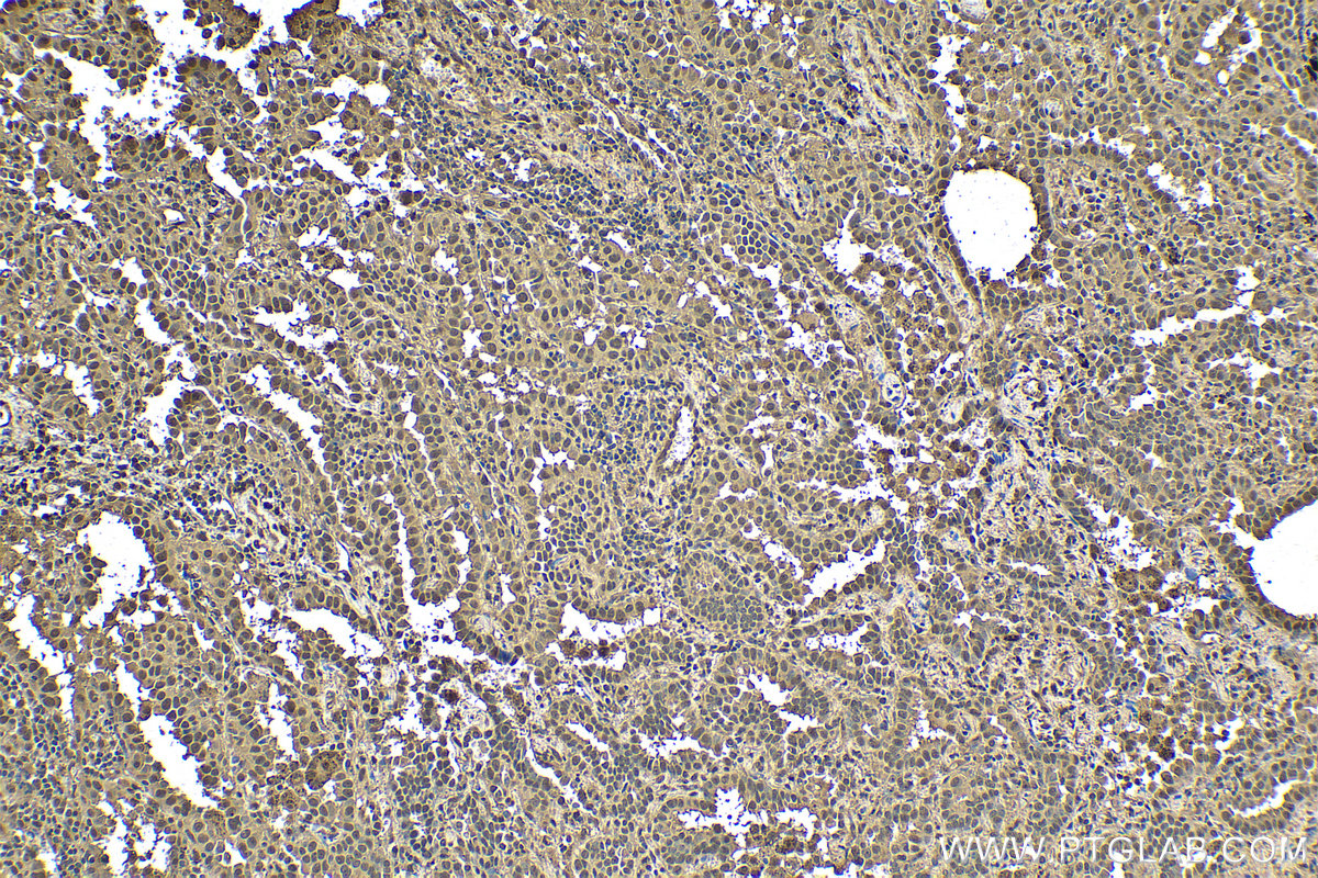 Immunohistochemistry (IHC) staining of human lung cancer tissue using ubiquitin Recombinant antibody (80992-1-RR)