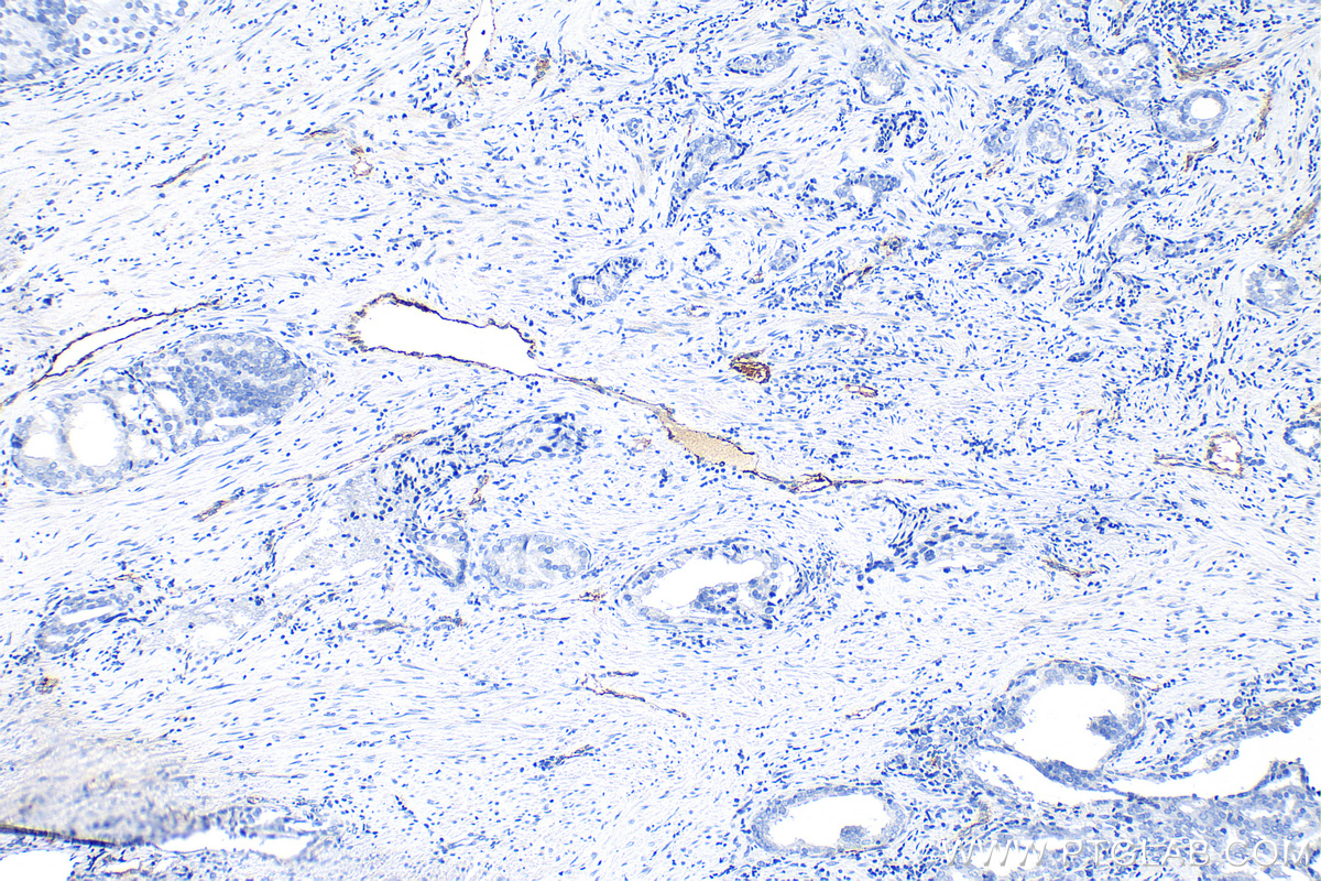 Immunohistochemistry (IHC) staining of human prostate cancer tissue using VWF Polyclonal antibody (27186-1-AP)