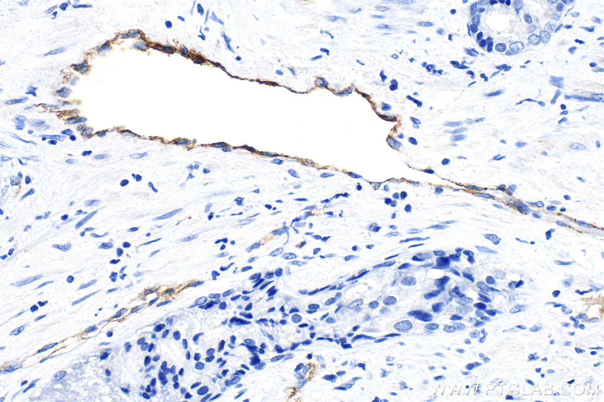 Immunohistochemistry (IHC) staining of human prostate cancer tissue using VWF Polyclonal antibody (27186-1-AP)