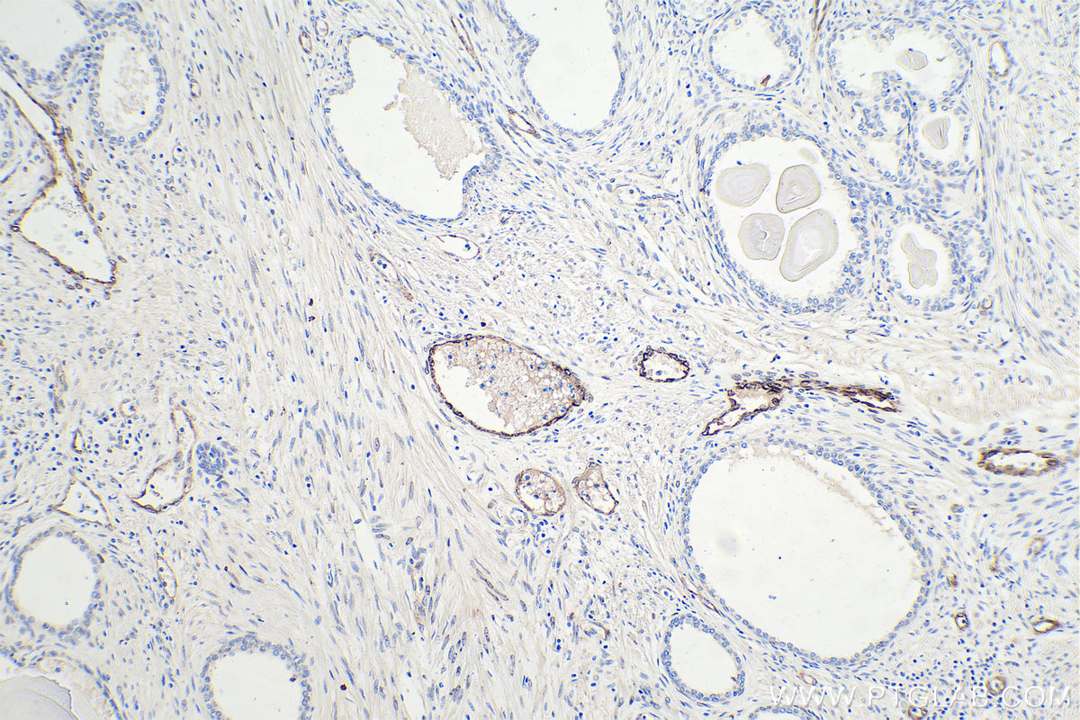 Immunohistochemistry (IHC) staining of human prostate cancer tissue using VWF Monoclonal antibody (66682-1-Ig)