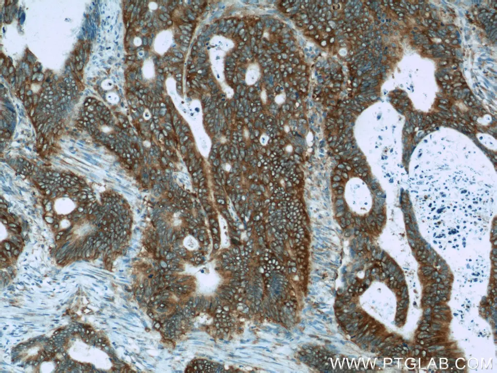 IHC staining of human colon cancer using APC polyclonal antibody