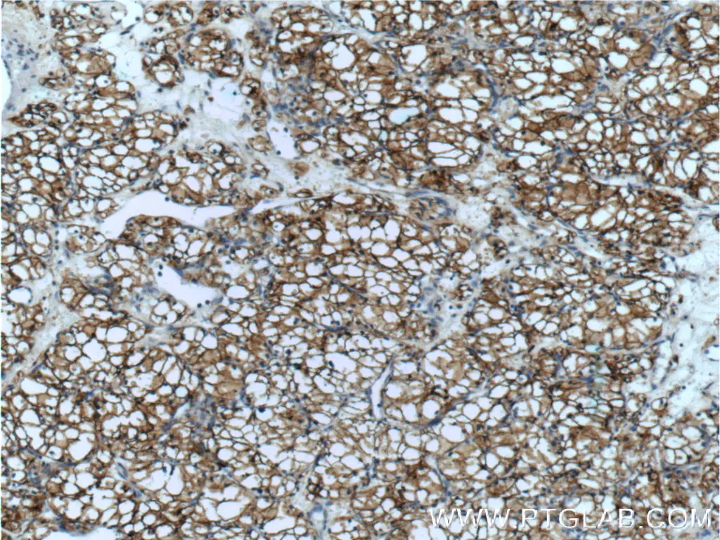 IHC staining of human renal cell carcinoma using CA9 antibody