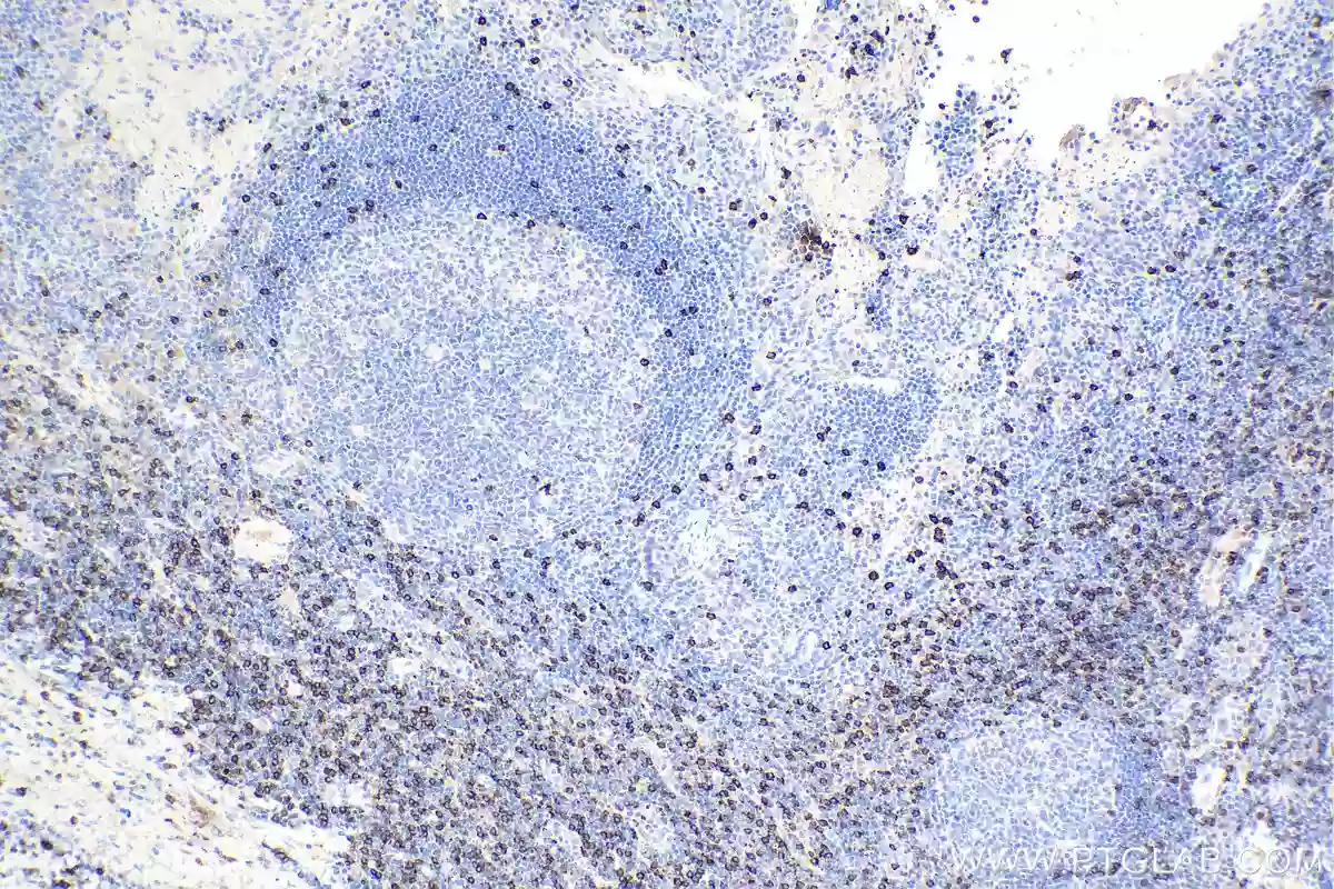 Immunohistochemistry of paraffin-embedded human tonsillitis tissue slide using CD8a antibody